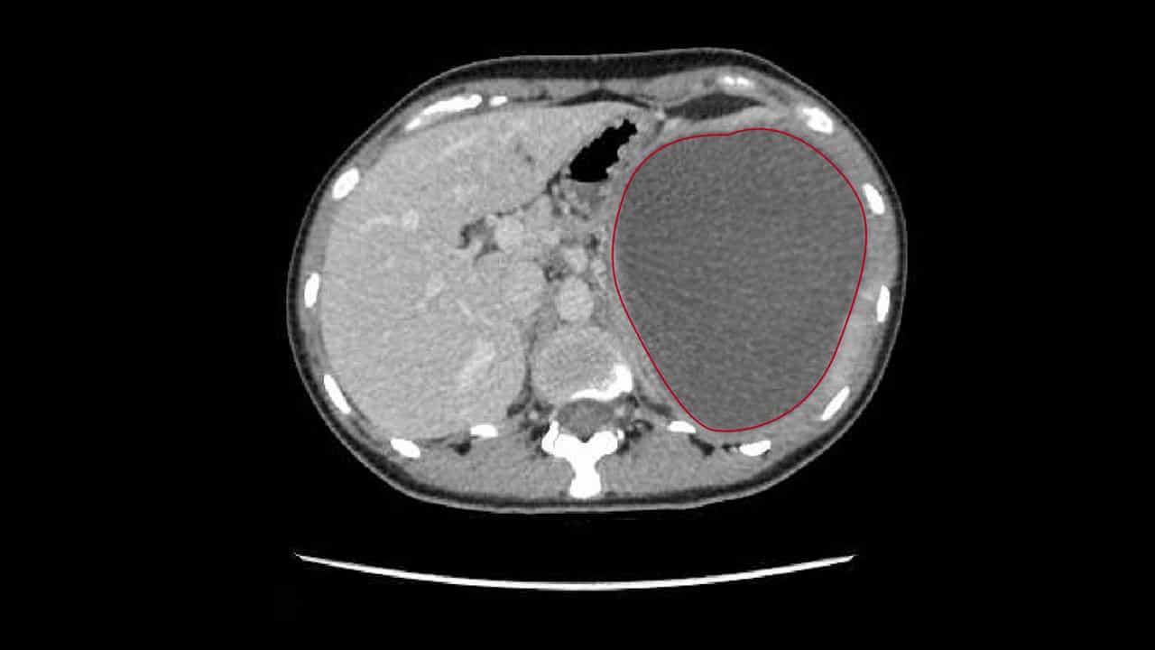 A CT scan of the watermelon-sized cyst