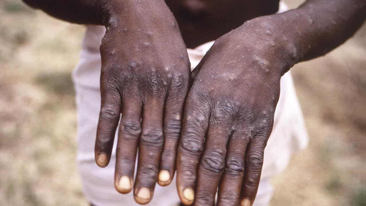 A man with mpox holds up his hands