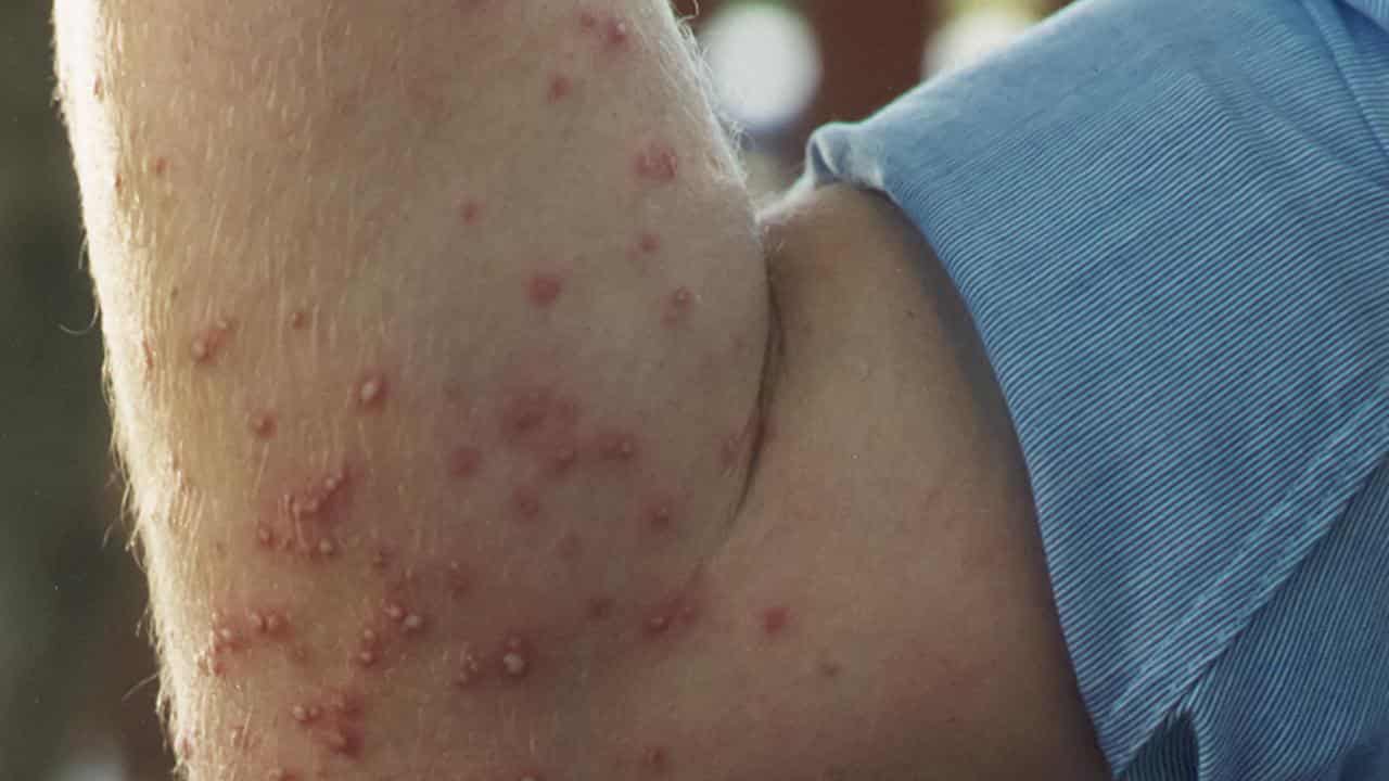 Fire ant stings on a man's arm