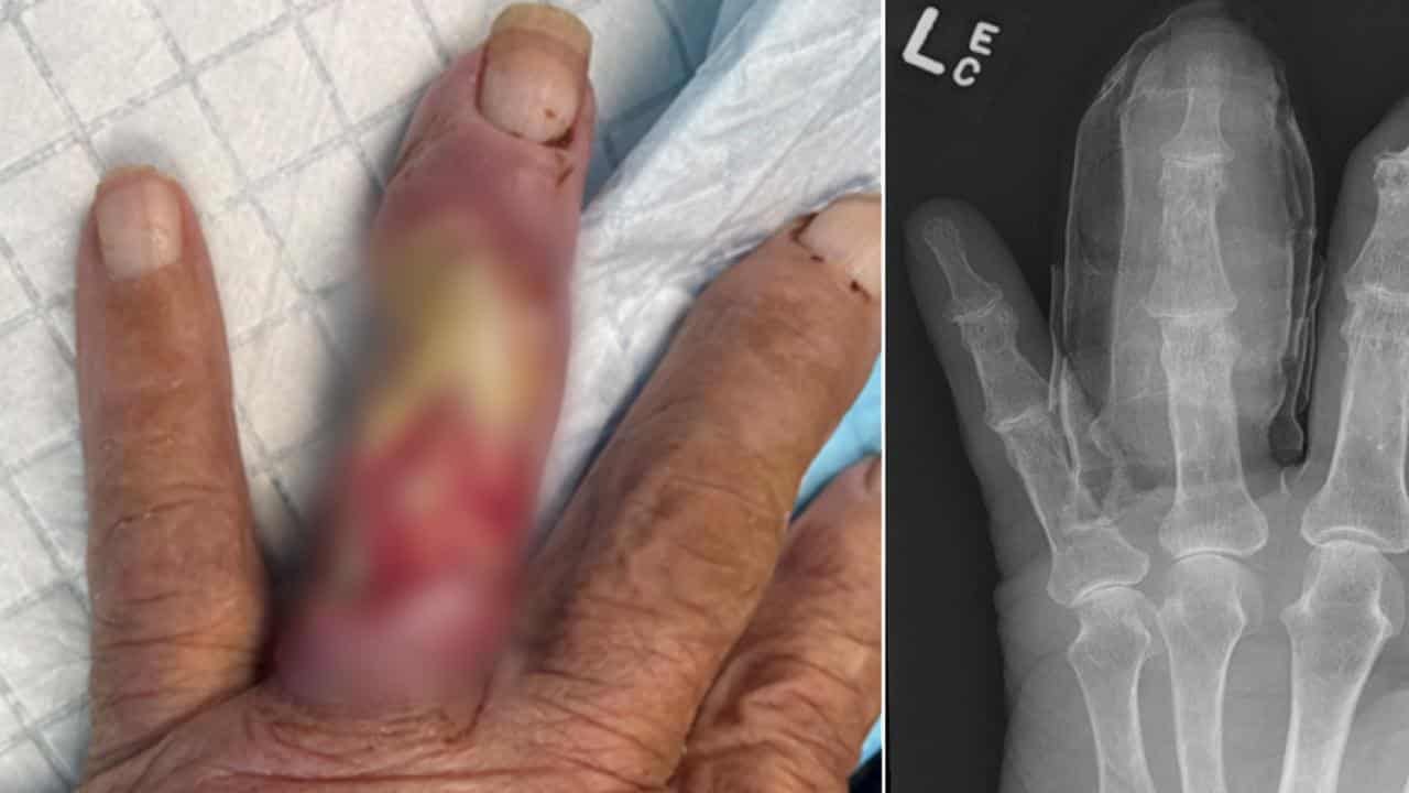 A man's finger infected with Buruli ulcer