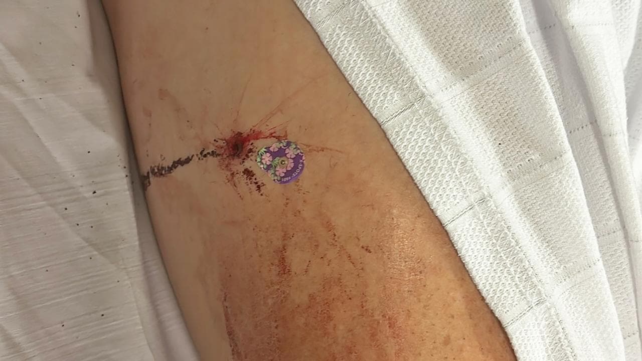 Wounds to the man