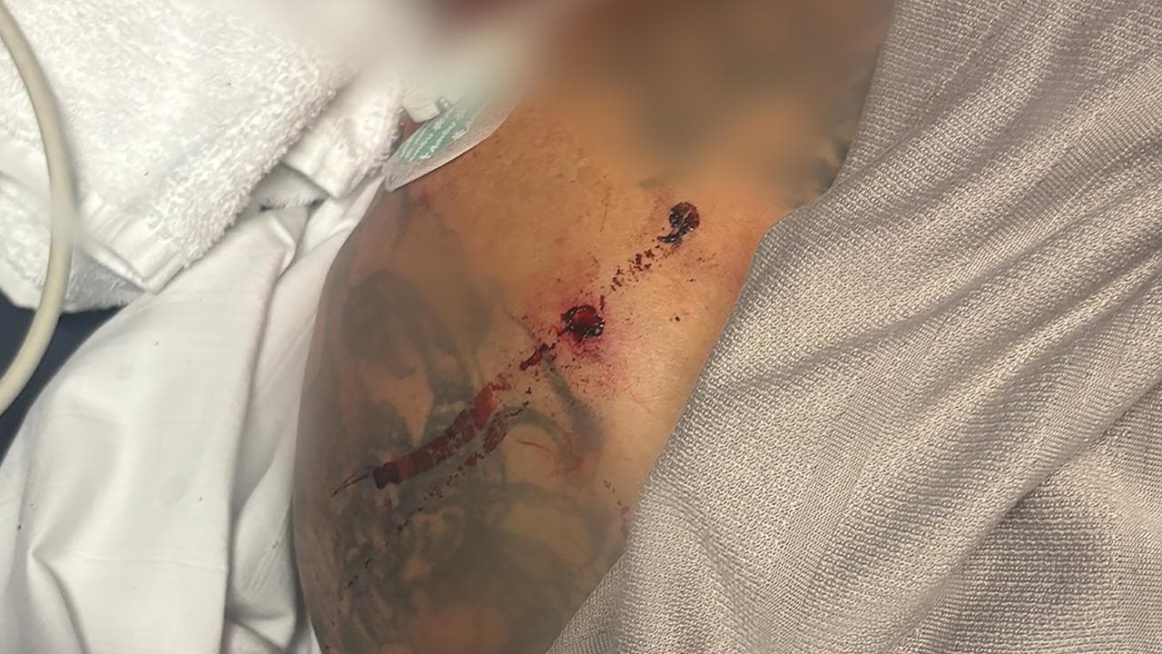 A gunshot wound