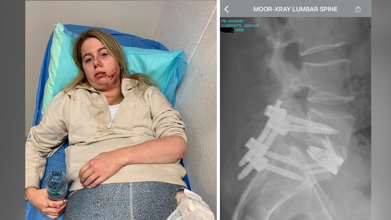 Elysse Lloyd and X-ray of Joshua Clements' spine