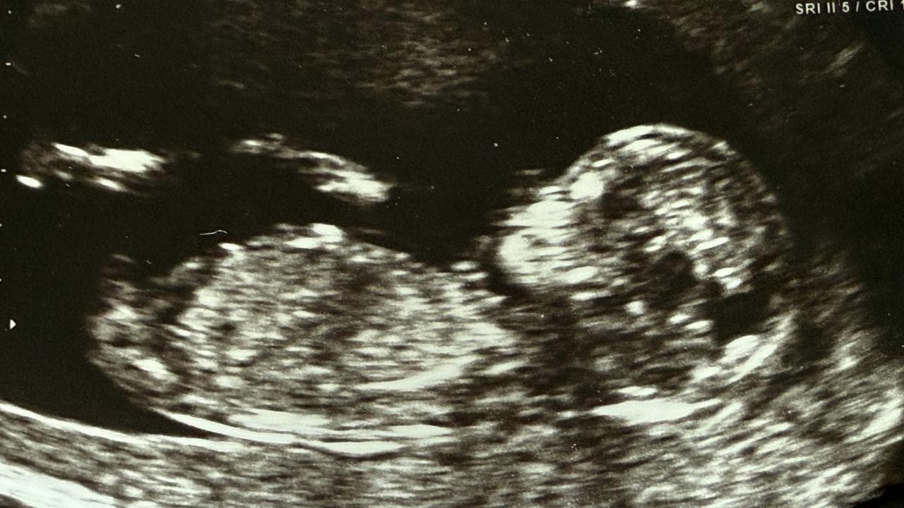An ultrasound