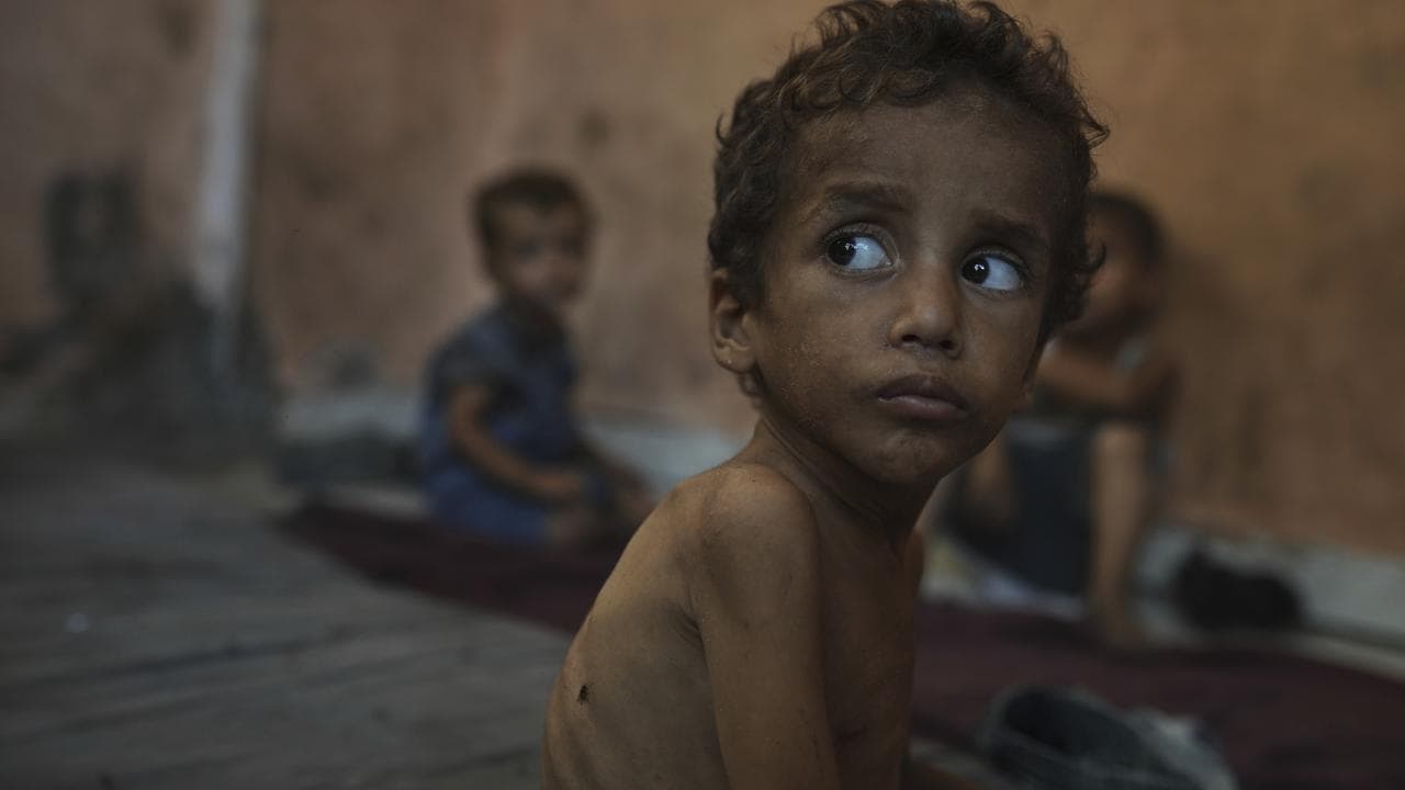 Yazan Abu Ful, a 2-year-old malnourished child in Gaza