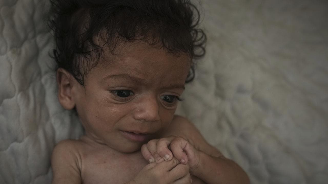 Seven-month-old Salem Awad, suffering from severe malnutrition