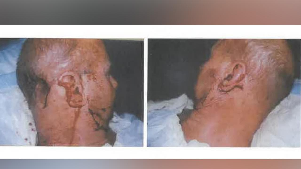 Man with ear partially bitten off by Walker (file)