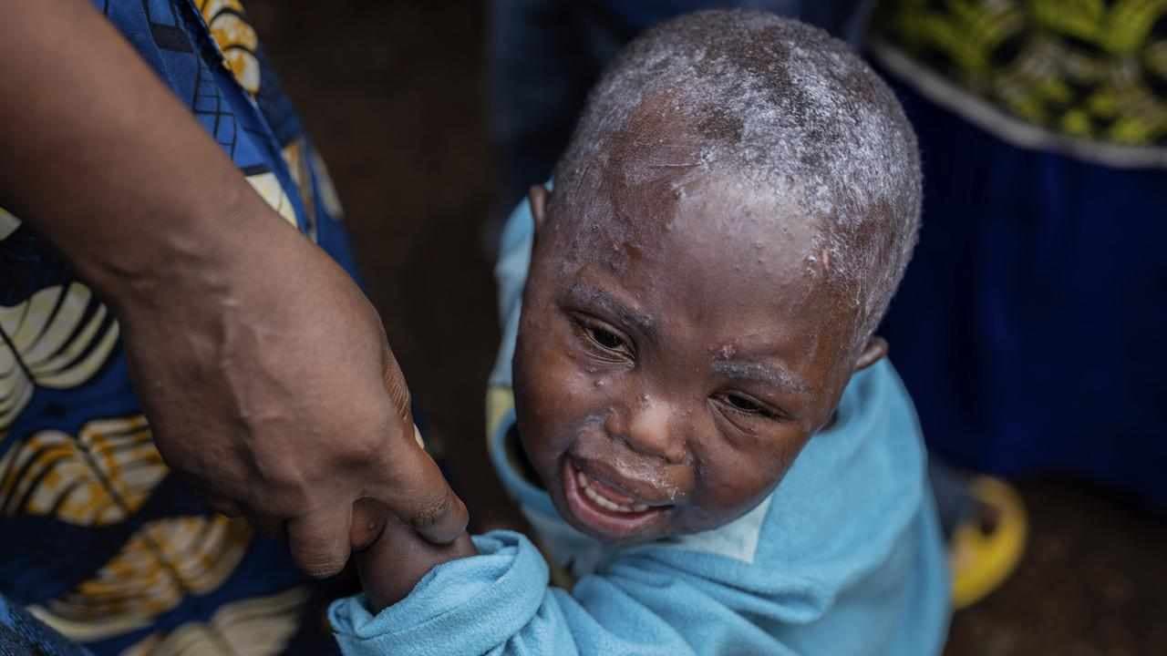 Old video used to belittle WHO's mpox emergency