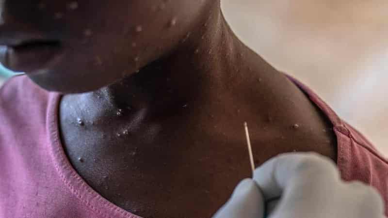 PNG mpox outbreak claims are viral misinformation