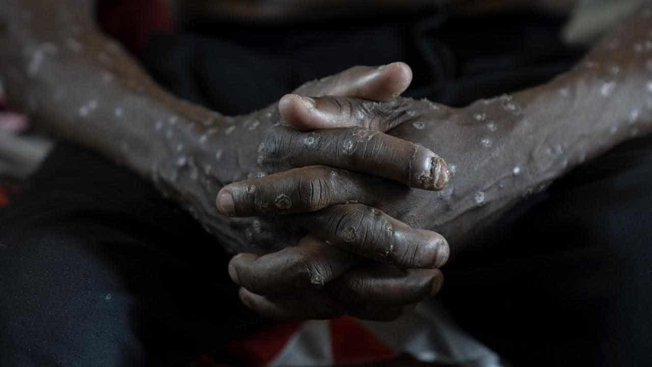 No, US government agency did not say there's no evidence of mpox