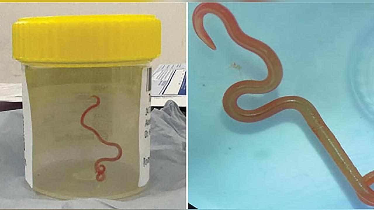 Python parasite found in woman's brain in world first