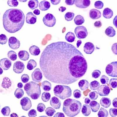 Complex blood cancer on the rise in Australia