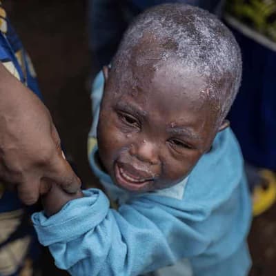 Old video used to belittle WHO's mpox emergency