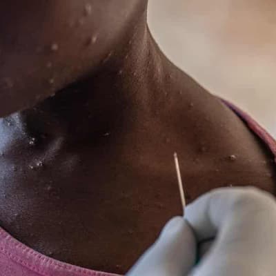 PNG mpox outbreak claims are viral misinformation
