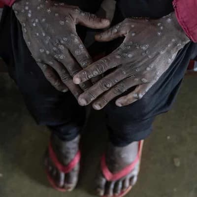 No, WHO has not ordered mpox ‘mega lockdowns’