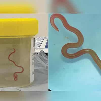 Python parasite found in woman's brain in world first